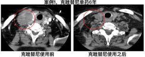 ALK靶向药克唑替尼总生存期竟超5年